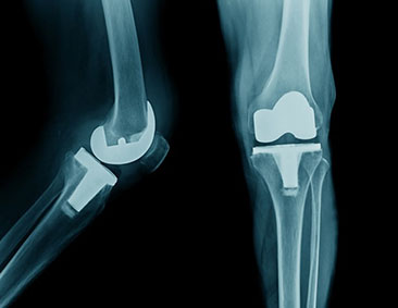 orthopedic surgeon in Lucknow